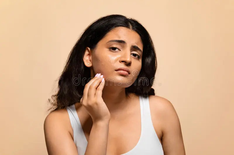 Why Women Get Acne and How to Treat It Without Damaging Skin