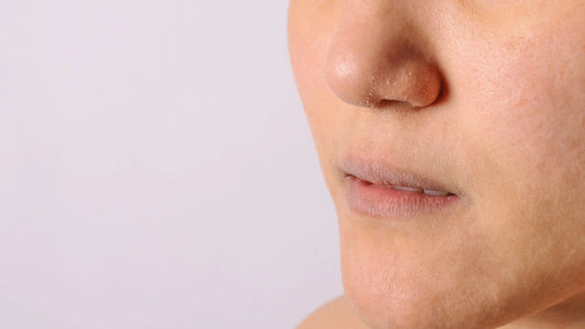 Winter Skincare Survival Guide: Fighting Dryness, Dullness, and Flakiness in Cold Weather