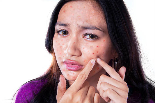 Acne Control Basics: Essential Ingredients That Fight Breakouts Without Over-Drying