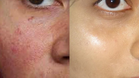 Hyaluronic Acid vs. Glycerin: Which Hydrator Works Best for Deeply Dry Skin?