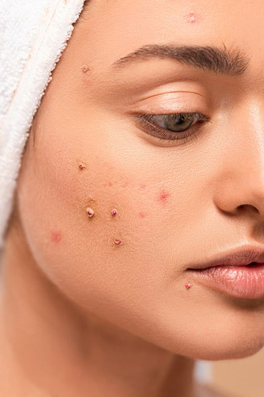 Post-Workout Skincare: 4 Quick Steps to Prevent Breakouts After the Gym.