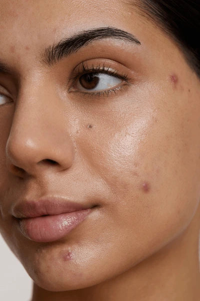 Why Isn’t Your Acne Going Away?