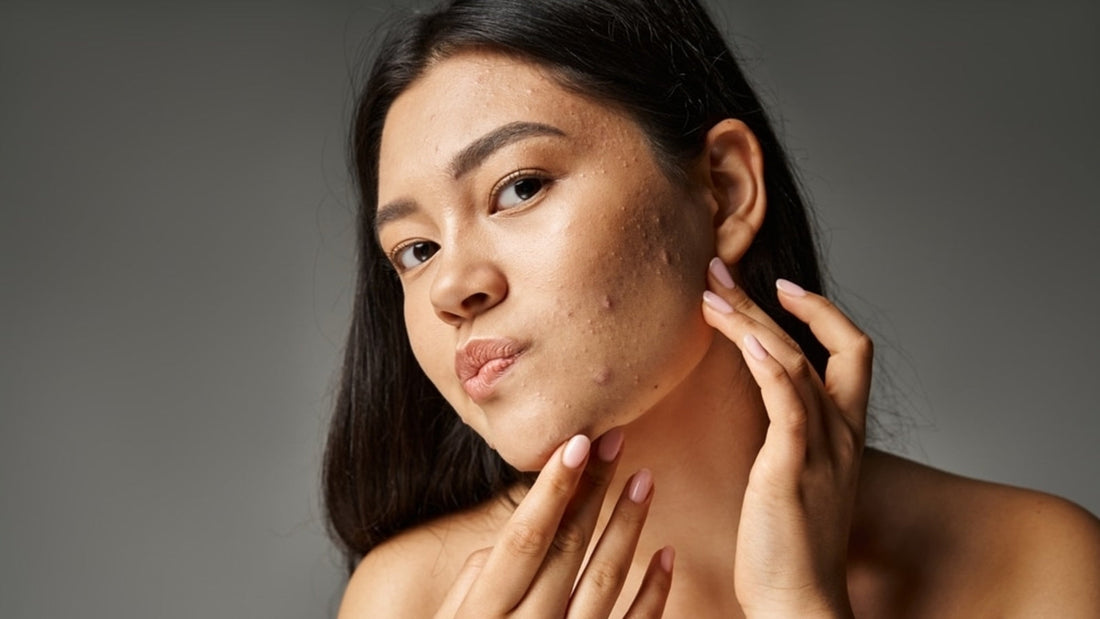 Hyaluronic Acid vs. Glycerin: Which Hydrator Works Best for Deeply Dry Skin?